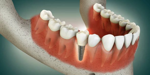 dental implants sis dental implants
