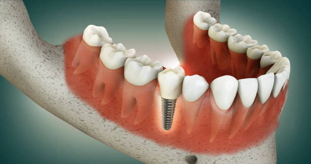 dental implants sis dental implants
