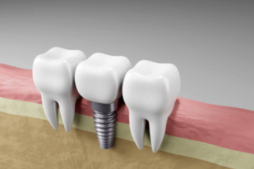 dental implants