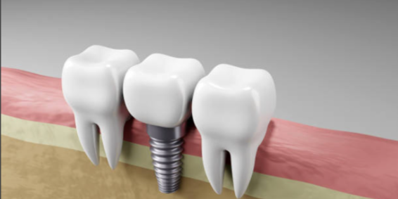 How-Dental-Implants-Can-Help-Prevent-Bone-Loss-and-Premature-Ageing-Google-Docs-09-23-2025_03_08_PM dental implants
