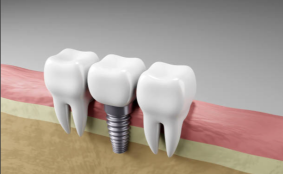 How-Dental-Implants-Can-Help-Prevent-Bone-Loss-and-Premature-Ageing-Google-Docs-09-23-2025_03_08_PM dental implants