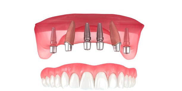 All-on-4 Dental Implants
