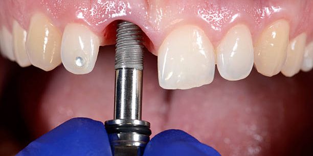 Can You Get Dental Implants If You Have Diabetes