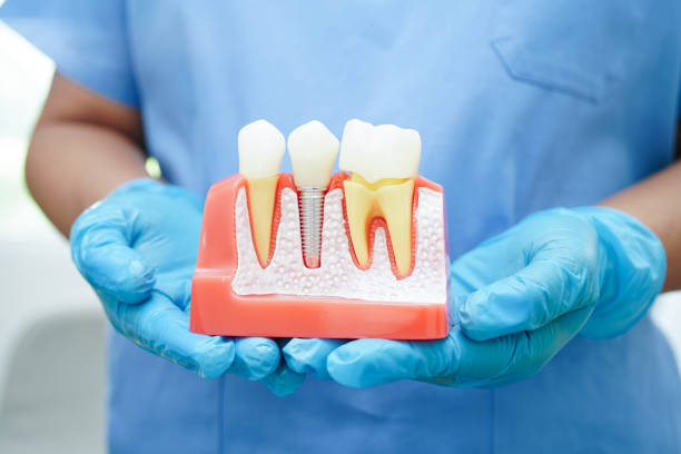 Understanding Dental Implants