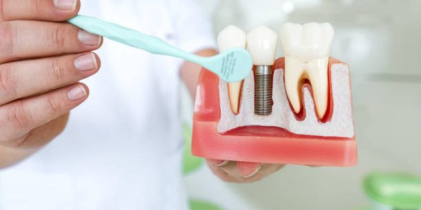 What Are Dental Implants?