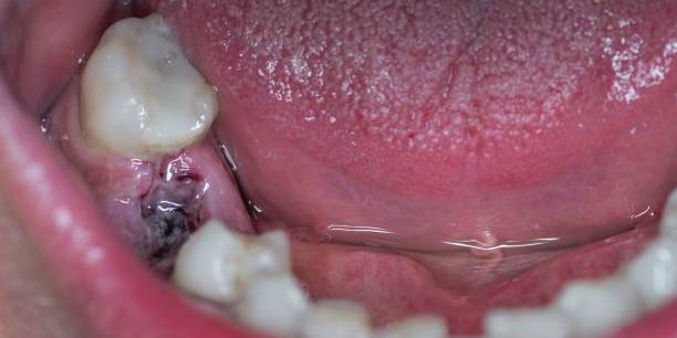 Can Dental Implants Cause Cancer?