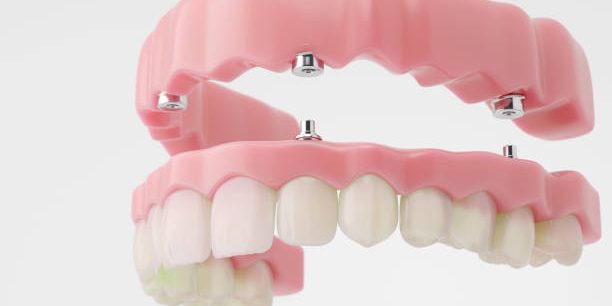 Full Mouth Dental Implants: One Surgery or Two?