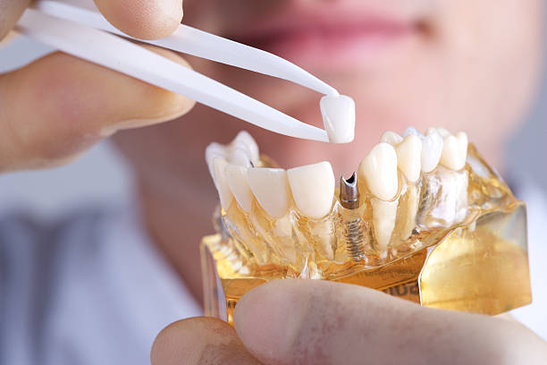 What Are Dental Implants, and What Are They Made Of?